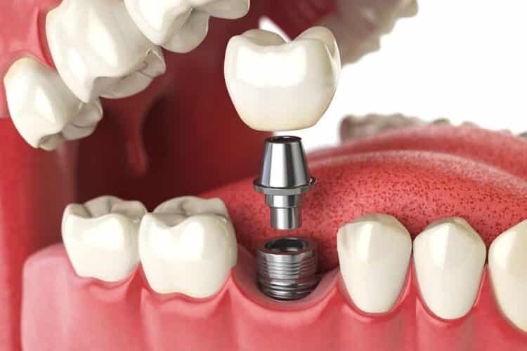 Zahnimplantate - was wird gemacht?