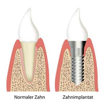 Zahnimplantat im Vergleich mit normalem Zahn