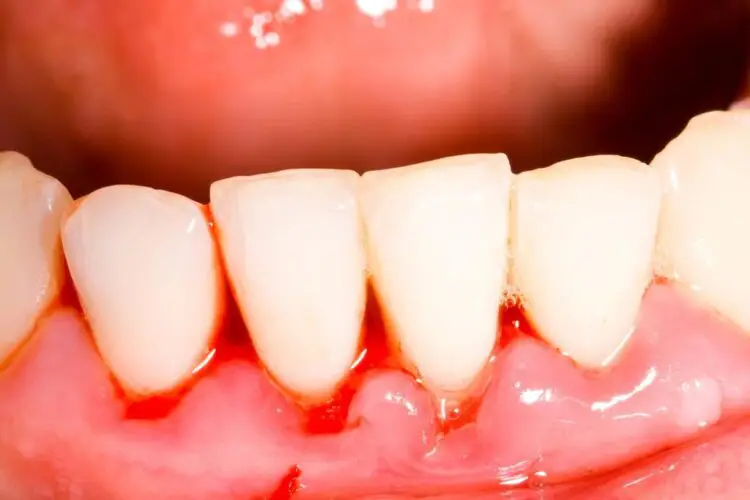 Eine Nahaufnahme eines Zahns, der sich einer Parodontitis-Behandlung unterzieht.