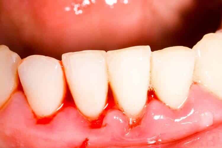 Eine Nahaufnahme eines blutbefleckten Zahns, der sich einer Parodontitisbehandlung unterzieht.