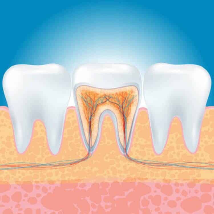 Eine Illustration eines Zahns, der sich einer Wurzelkanalbehandlung unterzieht.