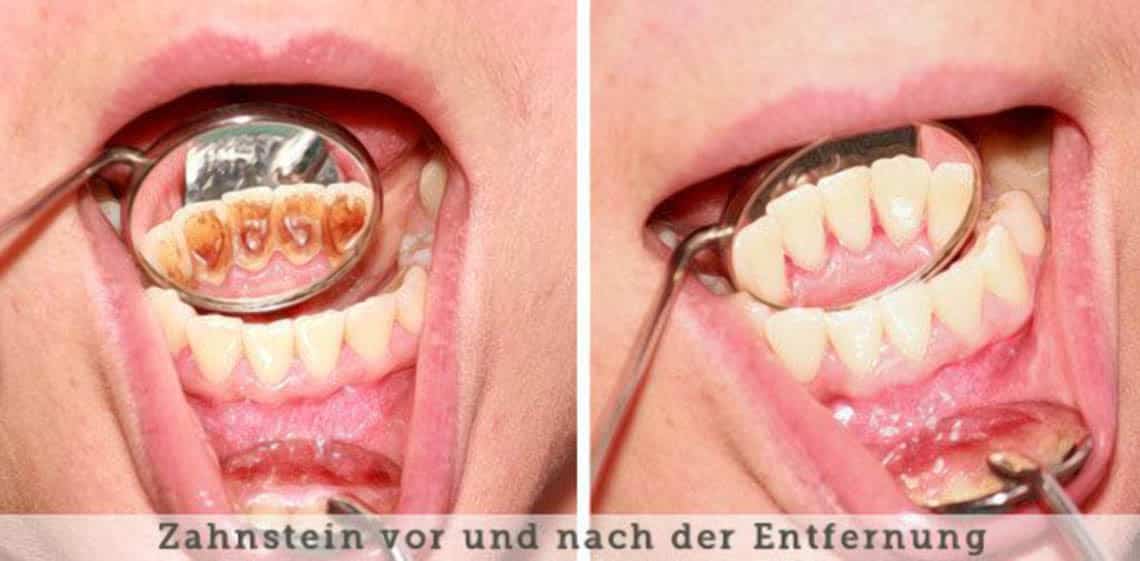 Wie kann man Zahnstein entfernen