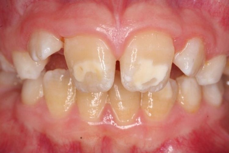 Eine Nahaufnahme der Zähne eines Patienten vor und nach der Behandlung zur Erkennung und Behandlung von Kreidezähnen.